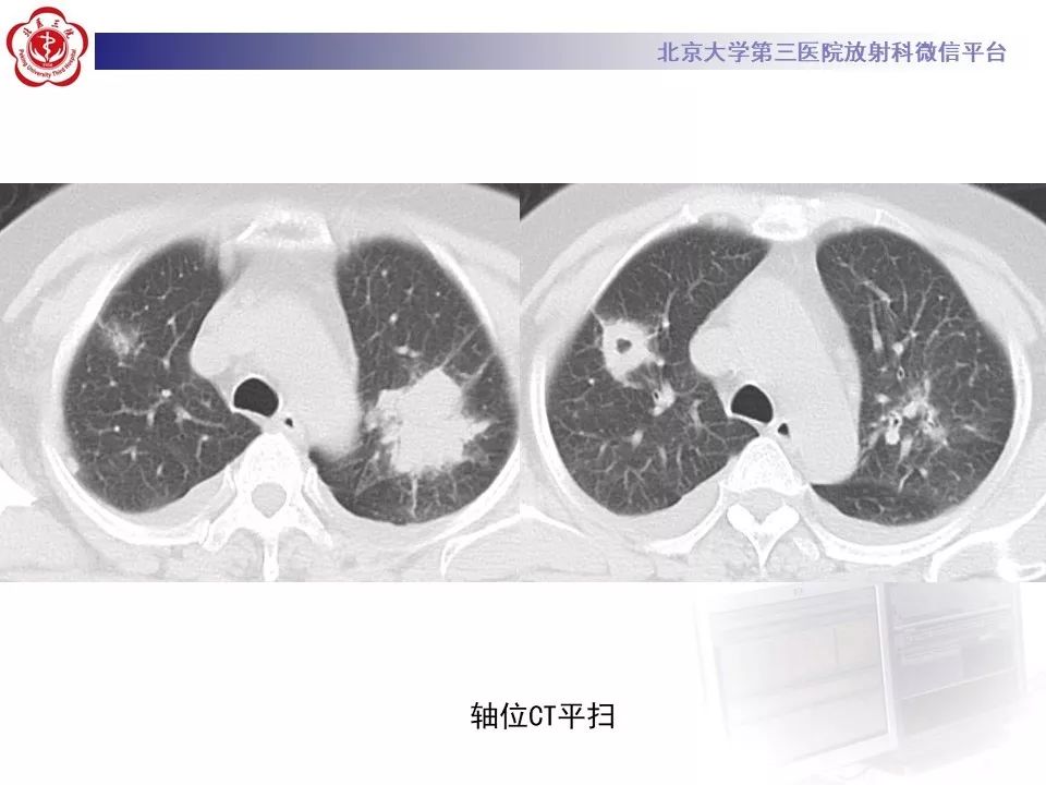 【PPT】肉芽肿性多血管炎/韦格纳肉芽的影像
