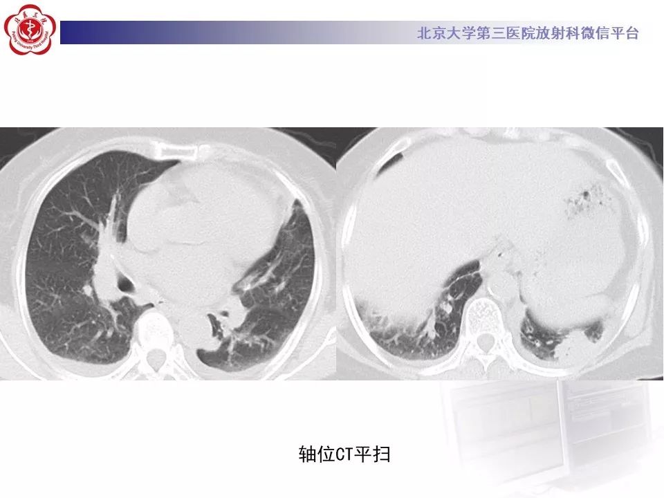 【PPT】肉芽肿性多血管炎/韦格纳肉芽的影像