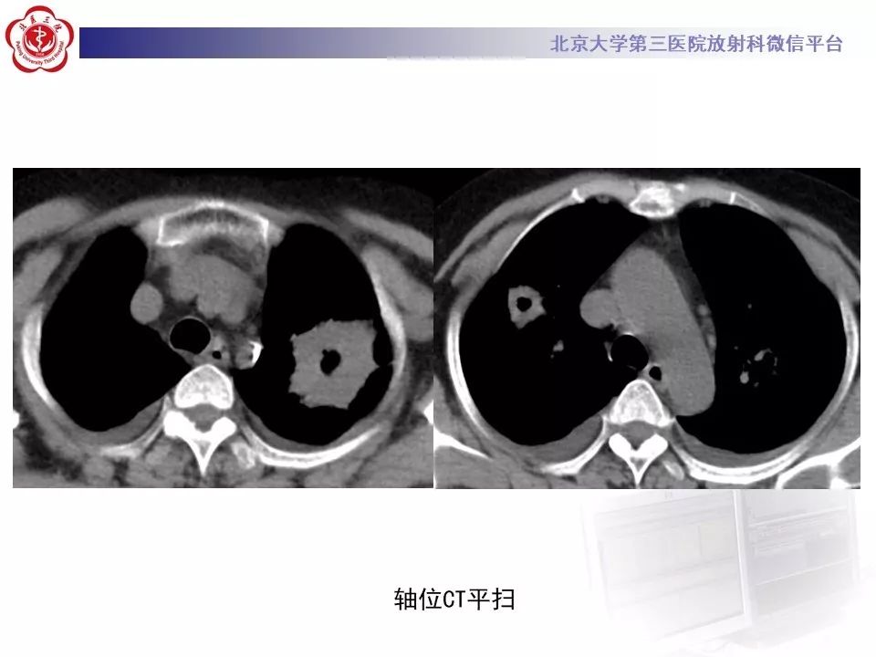 【PPT】肉芽肿性多血管炎/韦格纳肉芽的影像