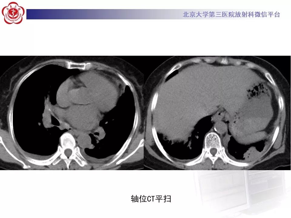 【PPT】肉芽肿性多血管炎/韦格纳肉芽的影像