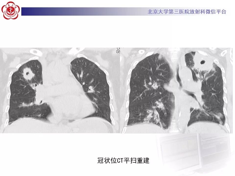 【PPT】肉芽肿性多血管炎/韦格纳肉芽的影像