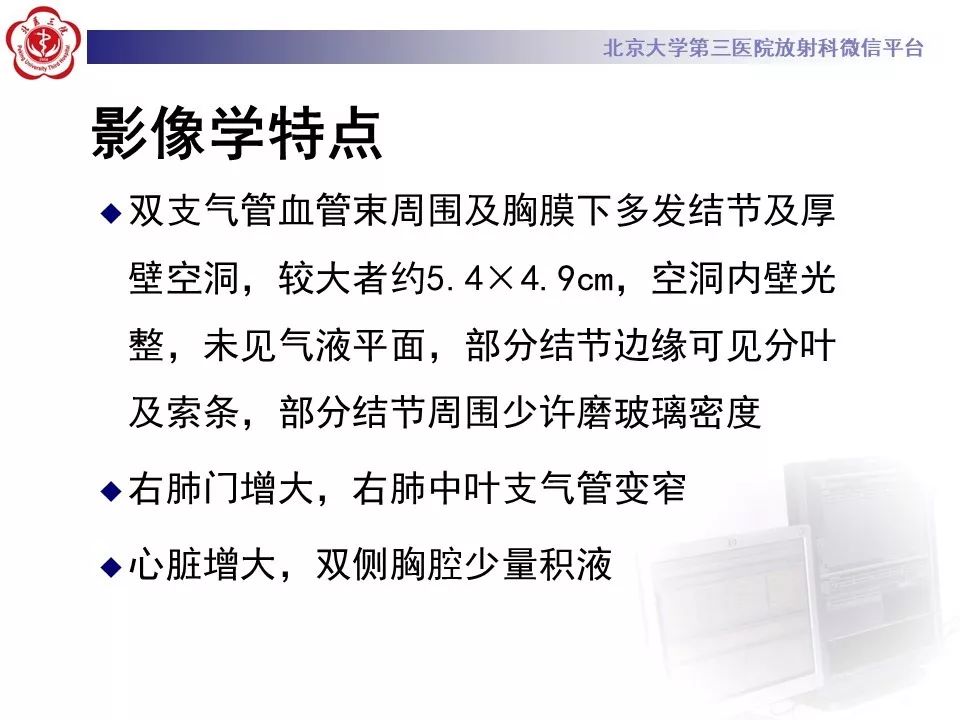 【PPT】肉芽肿性多血管炎/韦格纳肉芽的影像