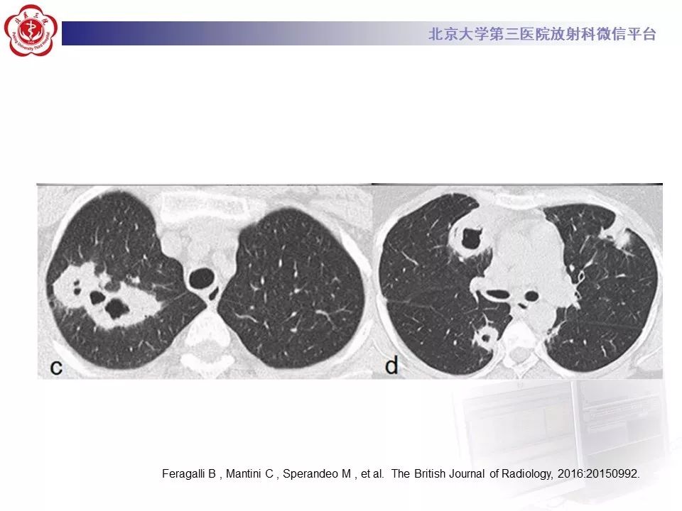 【PPT】肉芽肿性多血管炎/韦格纳肉芽的影像