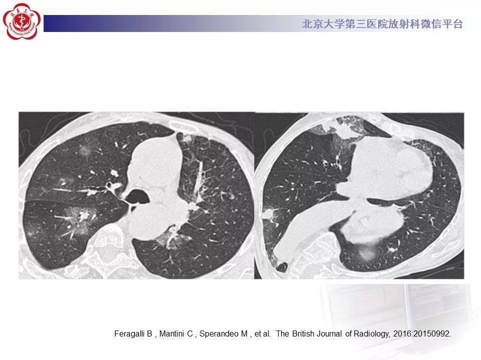 【PPT】肉芽肿性多血管炎/韦格纳肉芽的影像