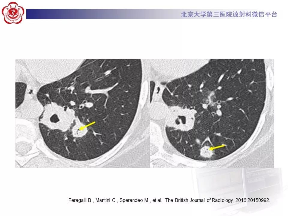 【PPT】肉芽肿性多血管炎/韦格纳肉芽的影像