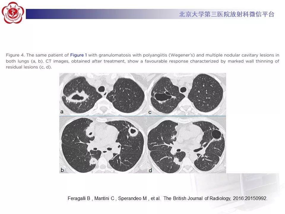 【PPT】肉芽肿性多血管炎/韦格纳肉芽的影像