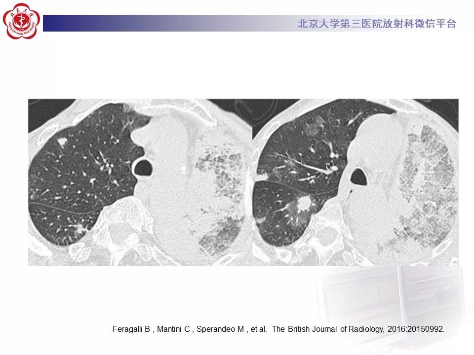 【PPT】肉芽肿性多血管炎/韦格纳肉芽的影像