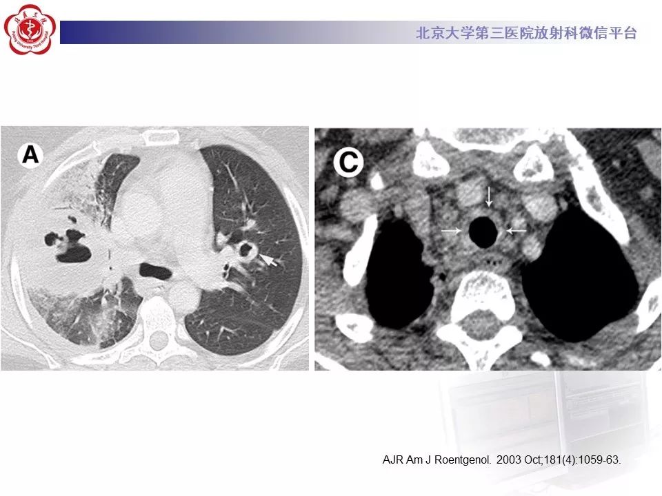 【PPT】肉芽肿性多血管炎/韦格纳肉芽的影像