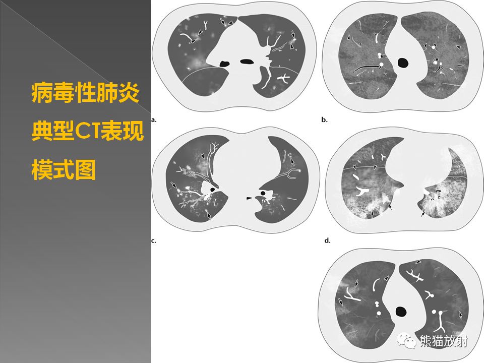 【PPT】病毒性肺炎的X线及CT表现