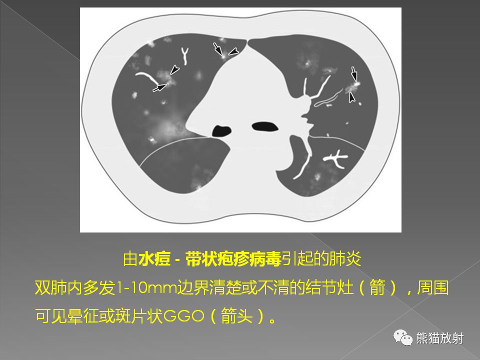 【PPT】病毒性肺炎的X线及CT表现