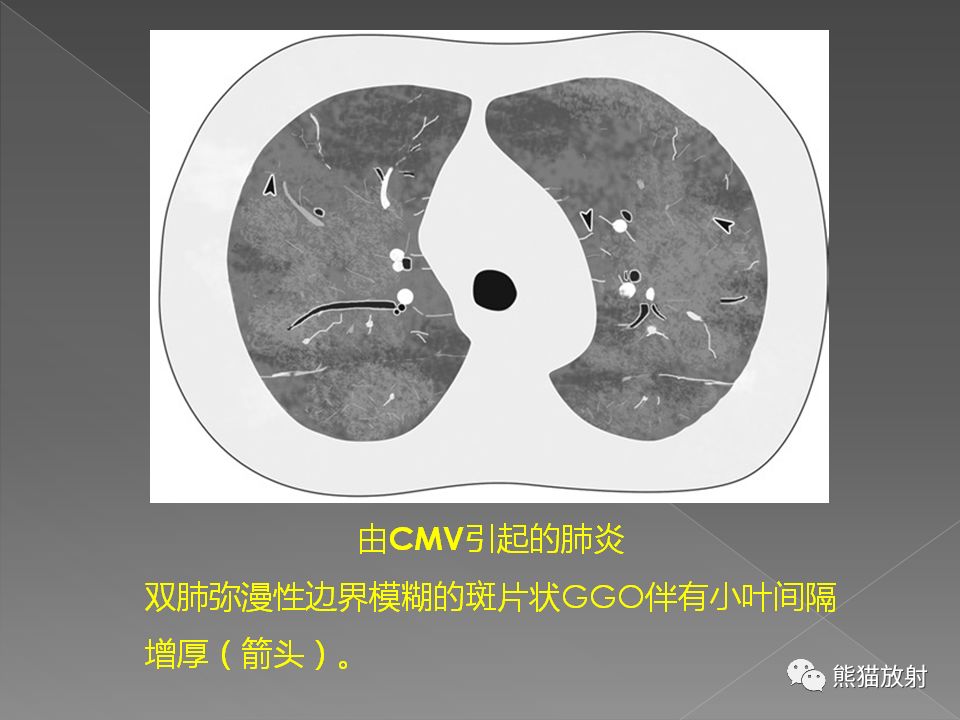 【PPT】病毒性肺炎的X线及CT表现