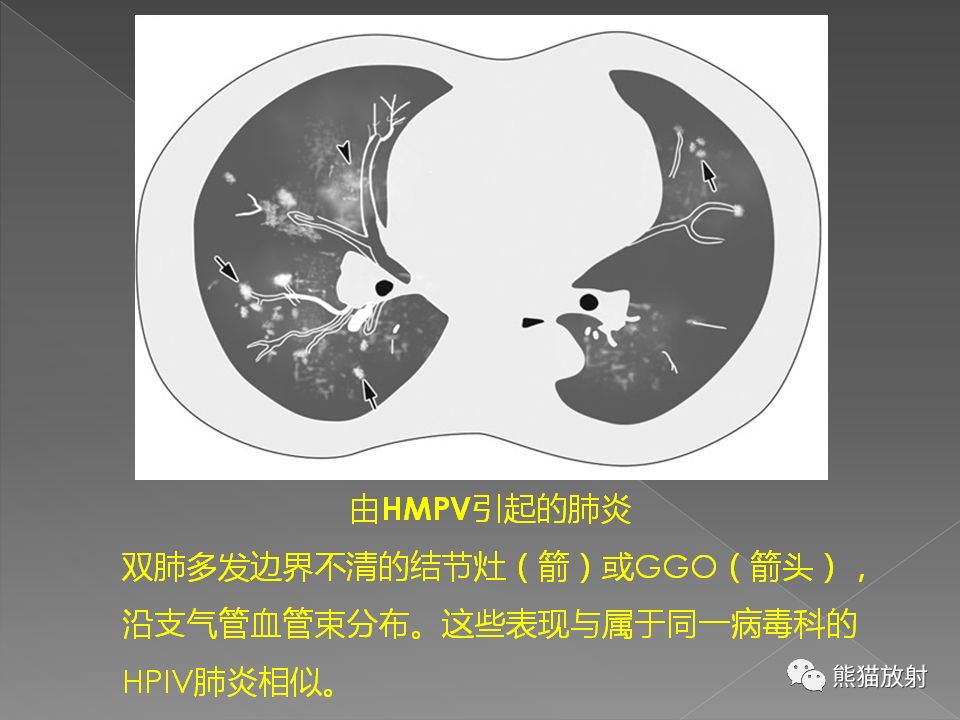 【PPT】病毒性肺炎的X线及CT表现