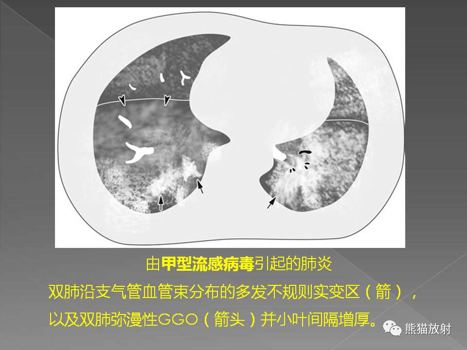 【PPT】病毒性肺炎的X线及CT表现