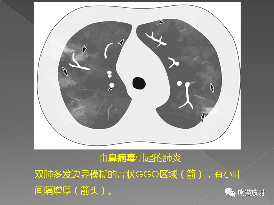【PPT】病毒性肺炎的X线及CT表现