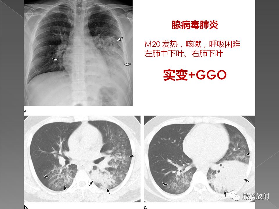 【PPT】病毒性肺炎的X线及CT表现