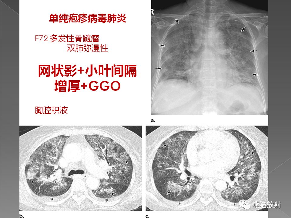 【PPT】病毒性肺炎的X线及CT表现
