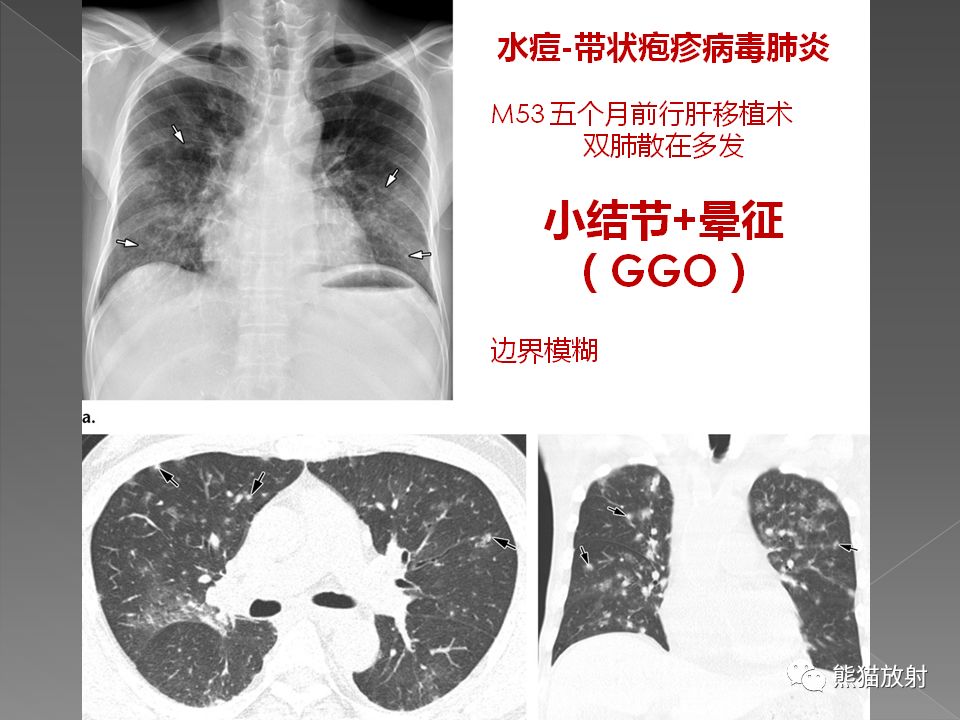 【PPT】病毒性肺炎的X线及CT表现