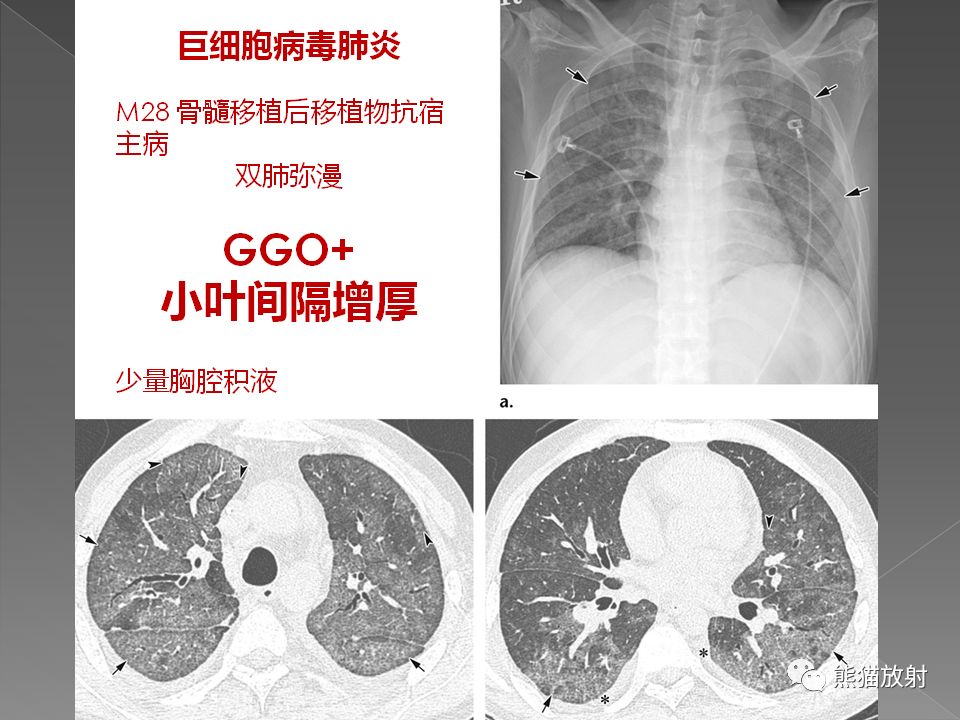 【PPT】病毒性肺炎的X线及CT表现