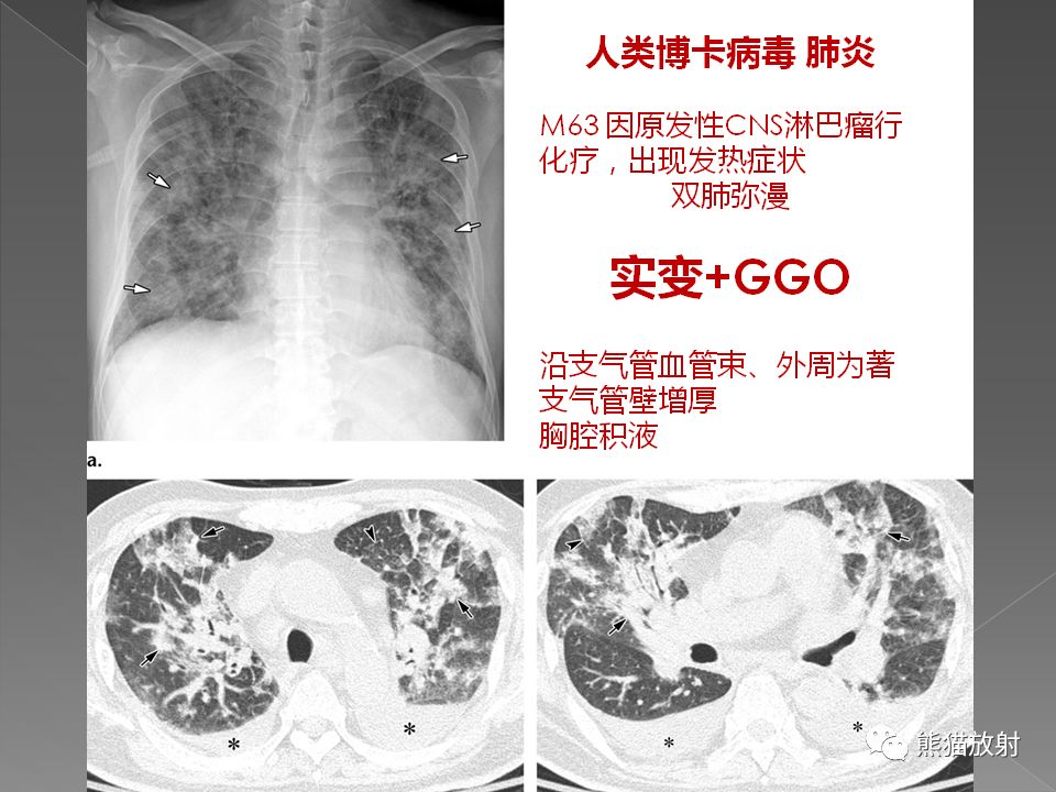 【PPT】病毒性肺炎的X线及CT表现