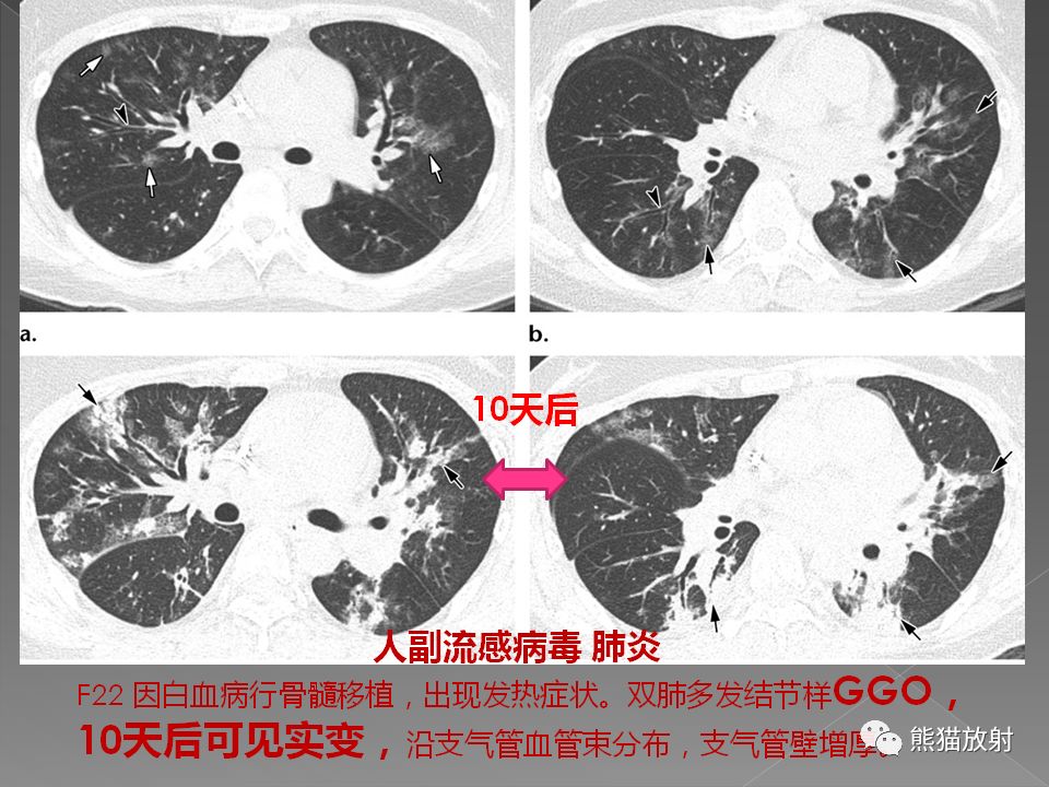 【PPT】病毒性肺炎的X线及CT表现