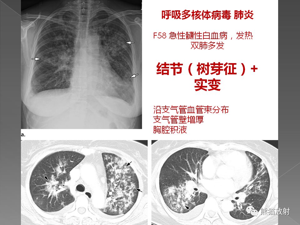 【PPT】病毒性肺炎的X线及CT表现