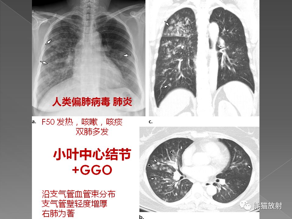 【PPT】病毒性肺炎的X线及CT表现
