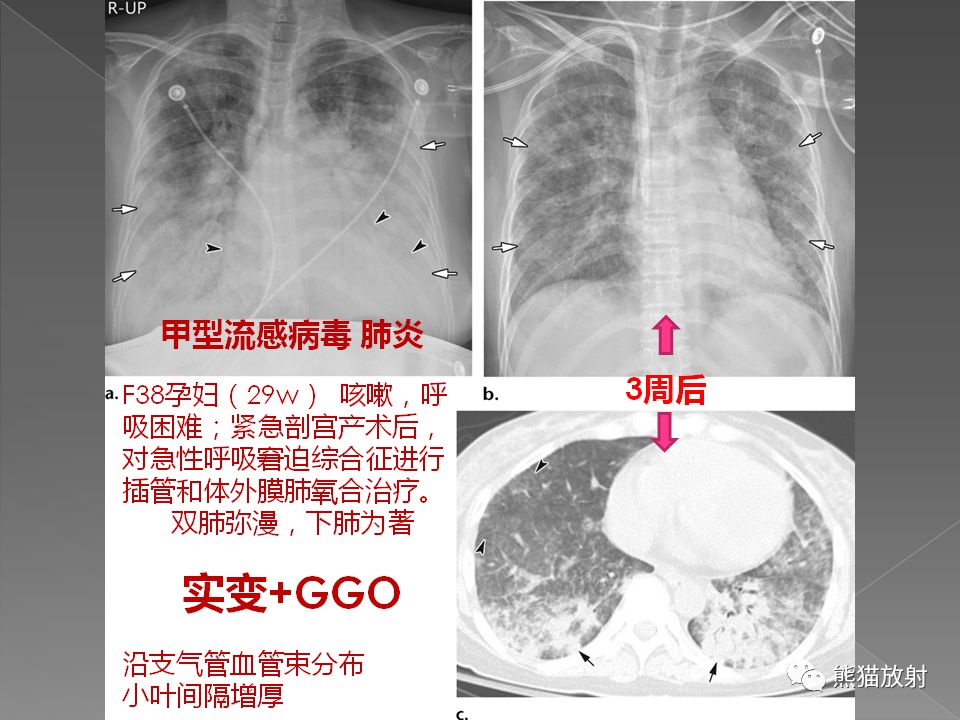 【PPT】病毒性肺炎的X线及CT表现