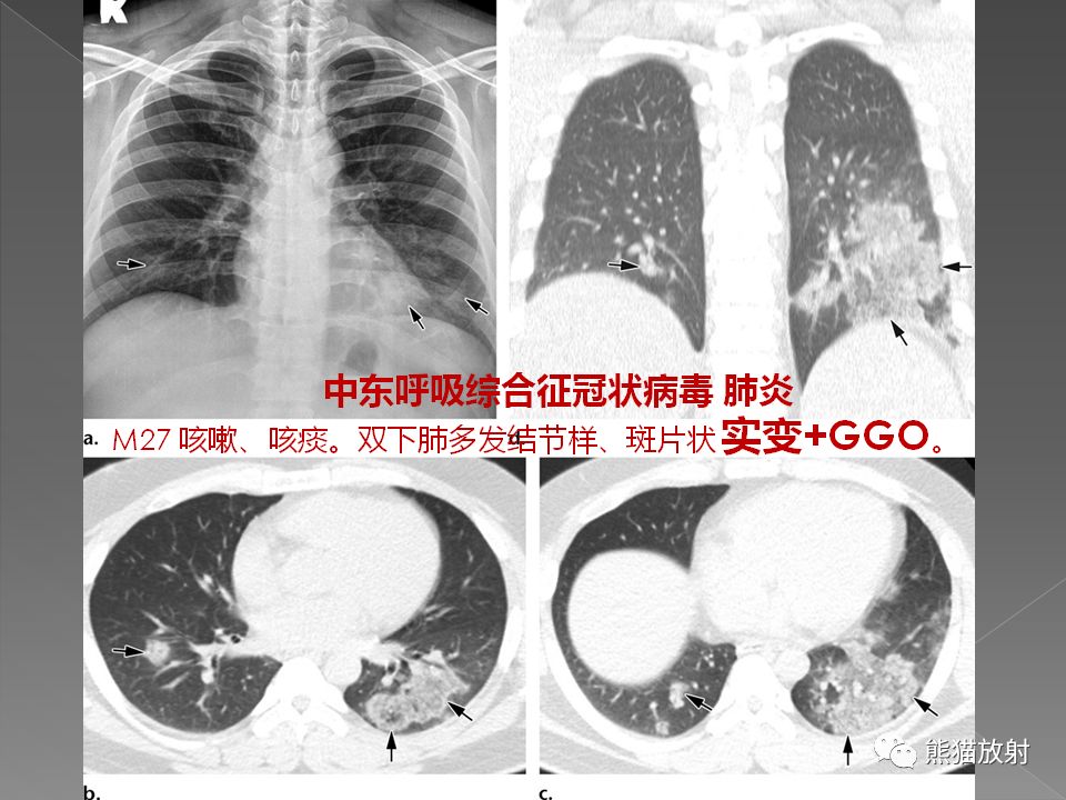 【PPT】病毒性肺炎的X线及CT表现