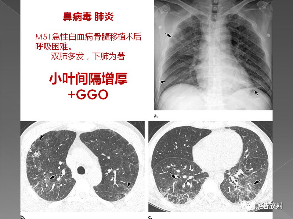 【PPT】病毒性肺炎的X线及CT表现
