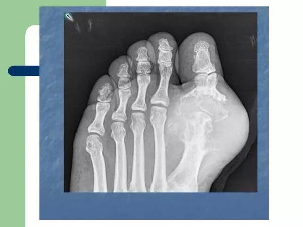 【PPT】痛风的影像表现