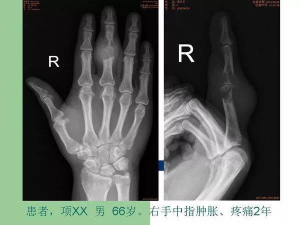 【PPT】痛风的影像表现