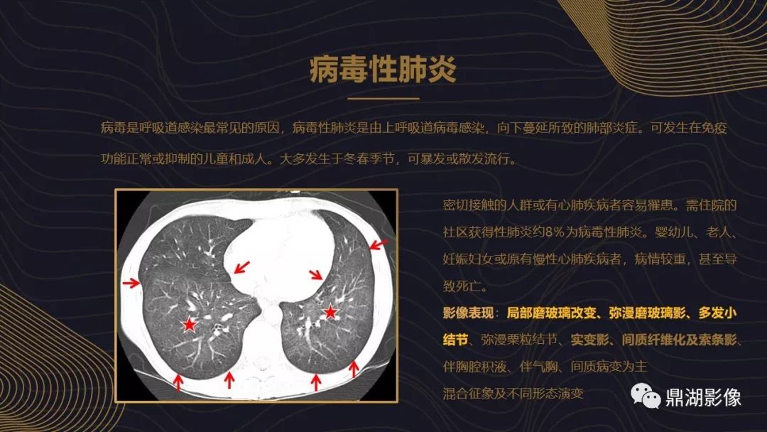【PPT】病毒性肺炎的相关知识学习