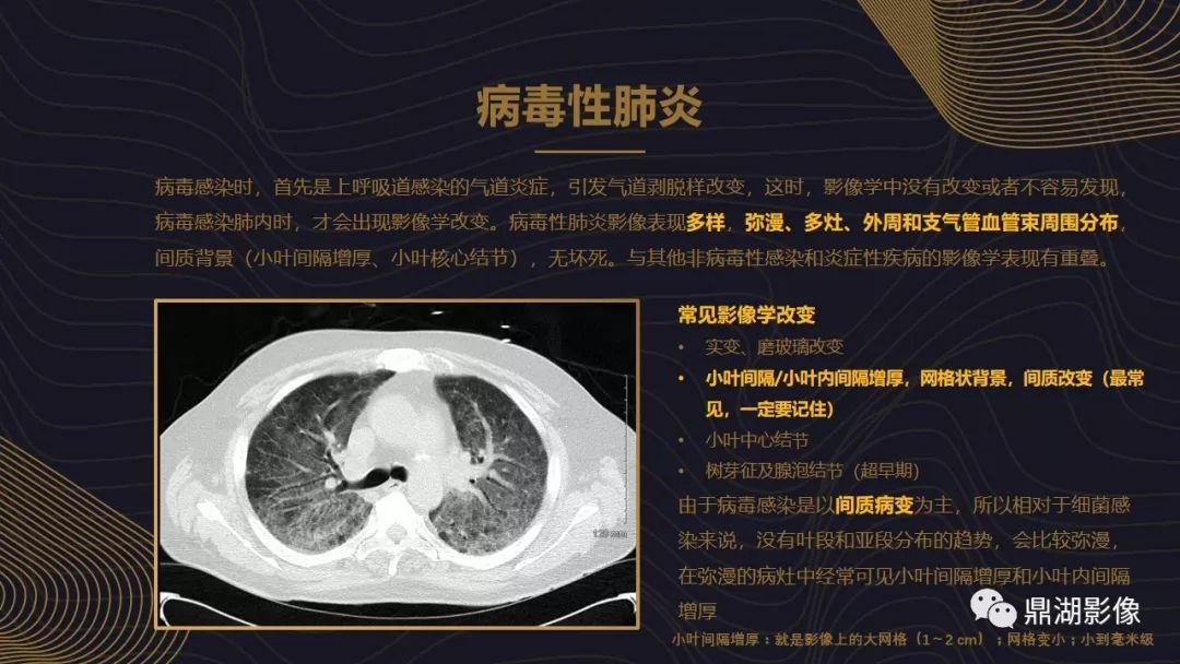 【PPT】病毒性肺炎的相关知识学习