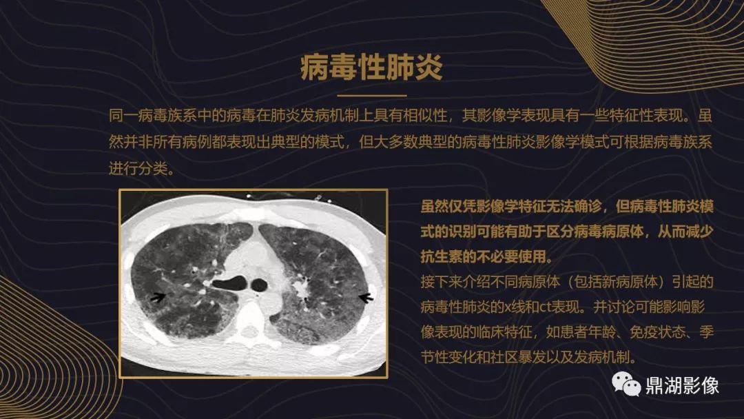 【PPT】病毒性肺炎的相关知识学习