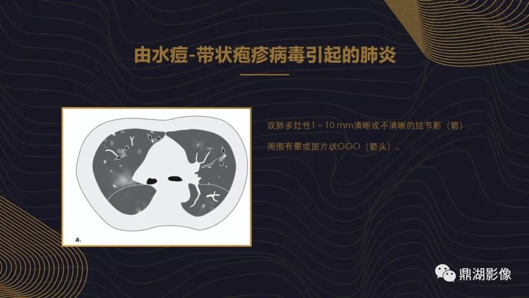 【PPT】病毒性肺炎的相关知识学习