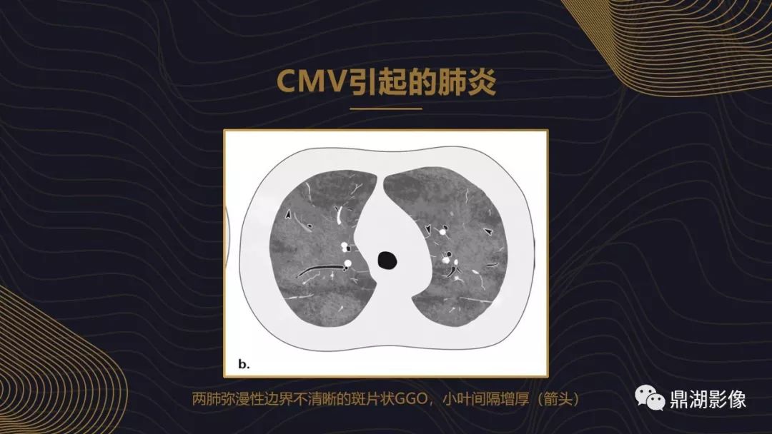 【PPT】病毒性肺炎的相关知识学习