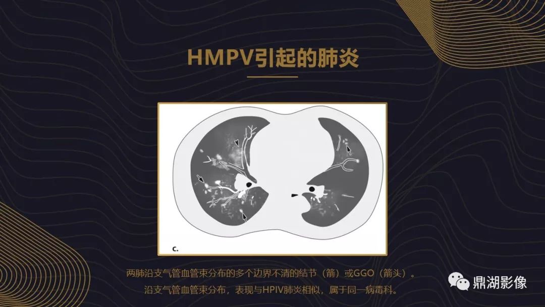 【PPT】病毒性肺炎的相关知识学习