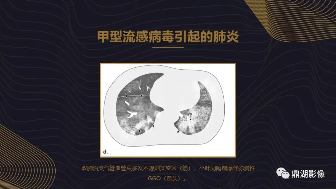 【PPT】病毒性肺炎的相关知识学习