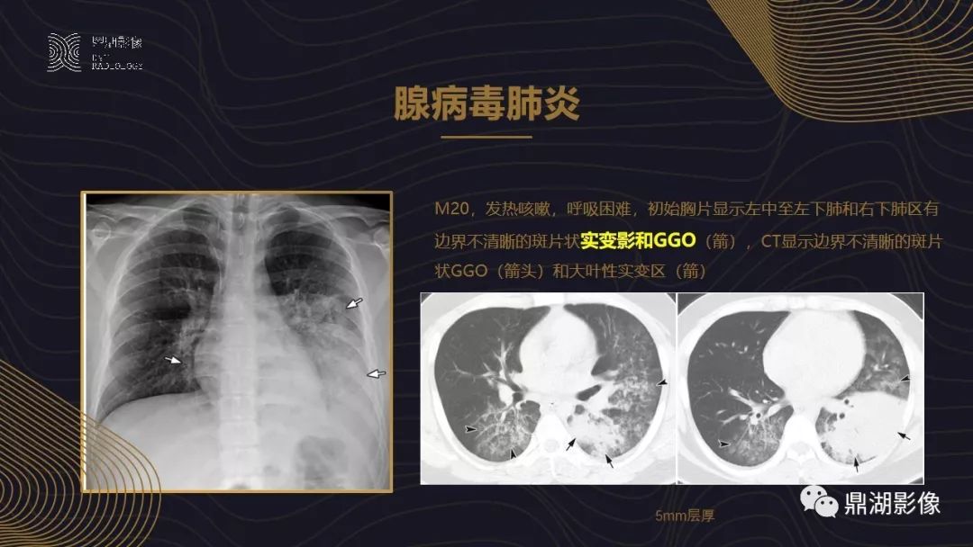 【PPT】病毒性肺炎的相关知识学习