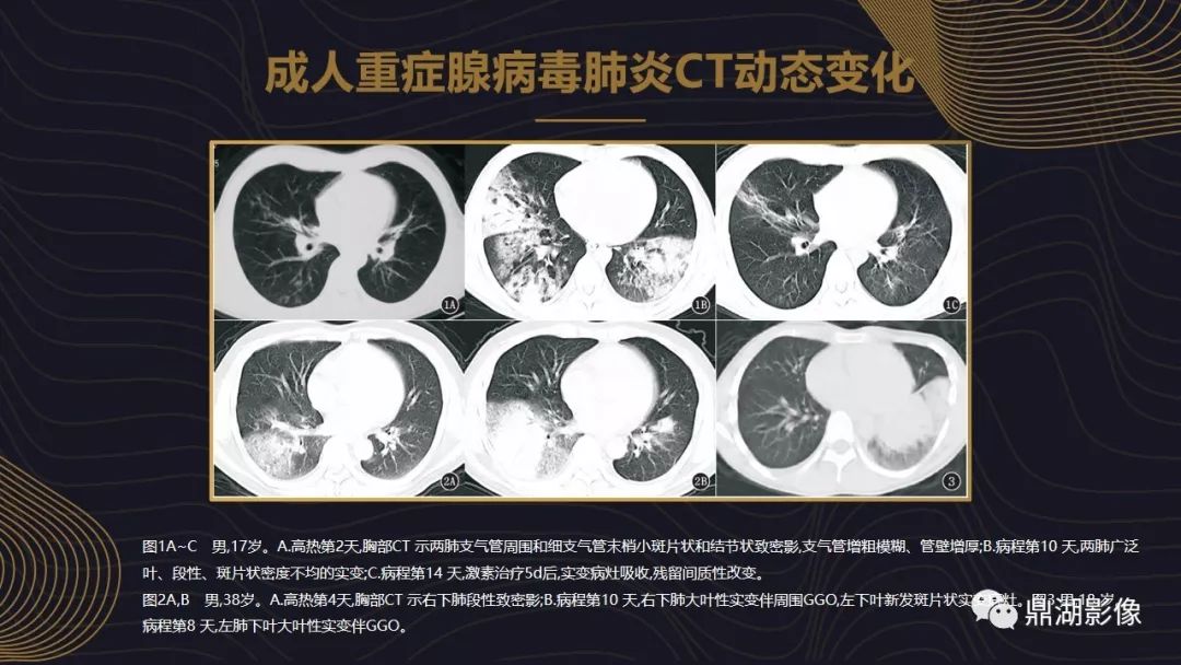 【PPT】病毒性肺炎的相关知识学习