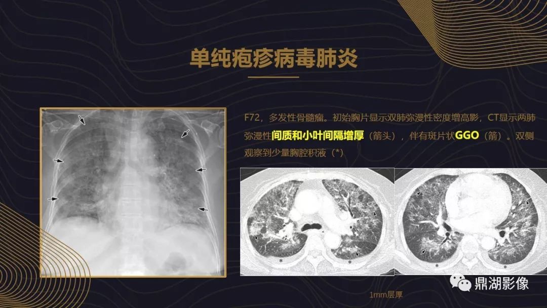 【PPT】病毒性肺炎的相关知识学习