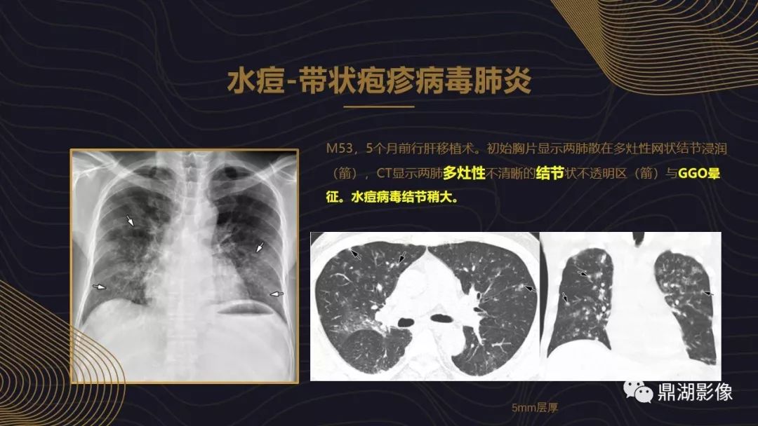 【PPT】病毒性肺炎的相关知识学习