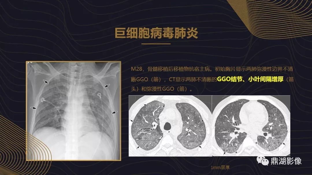 【PPT】病毒性肺炎的相关知识学习