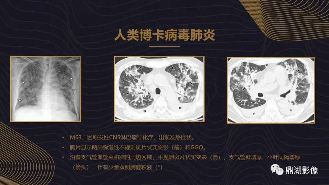 【PPT】病毒性肺炎的相关知识学习