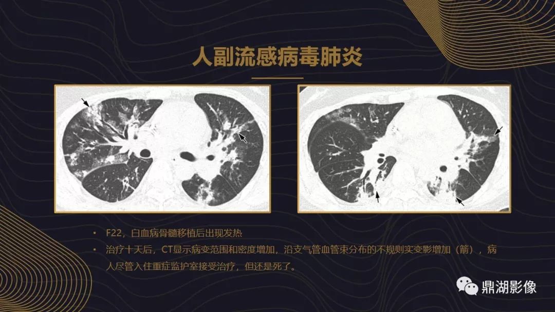【PPT】病毒性肺炎的相关知识学习