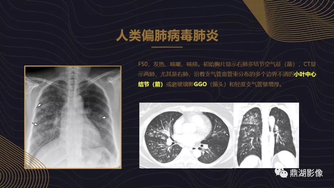 【PPT】病毒性肺炎的相关知识学习
