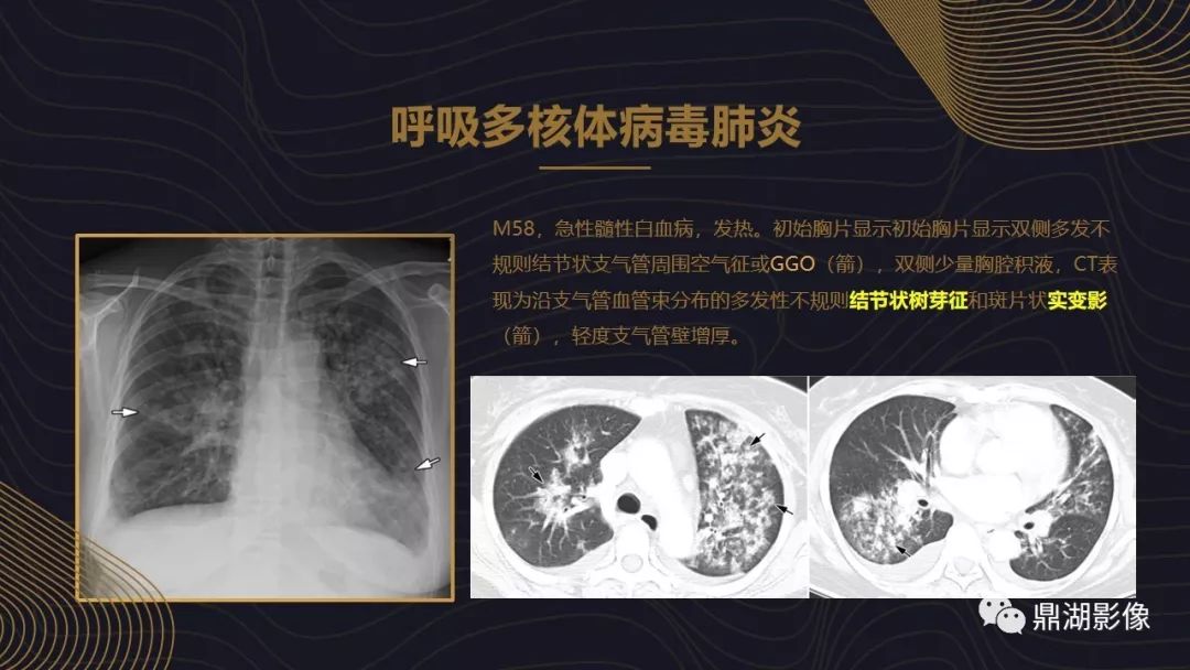 【PPT】病毒性肺炎的相关知识学习