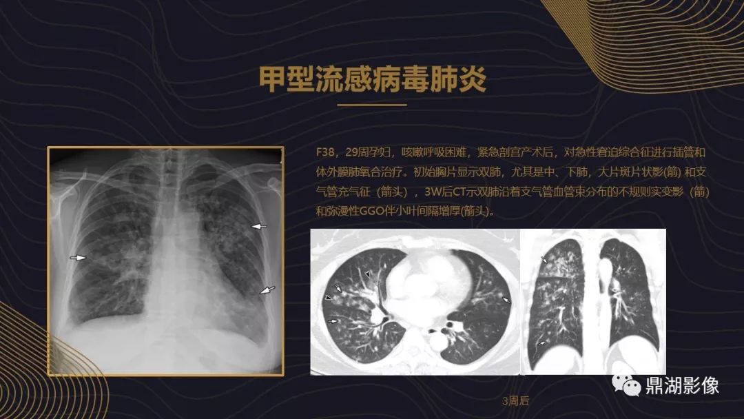 【PPT】病毒性肺炎的相关知识学习