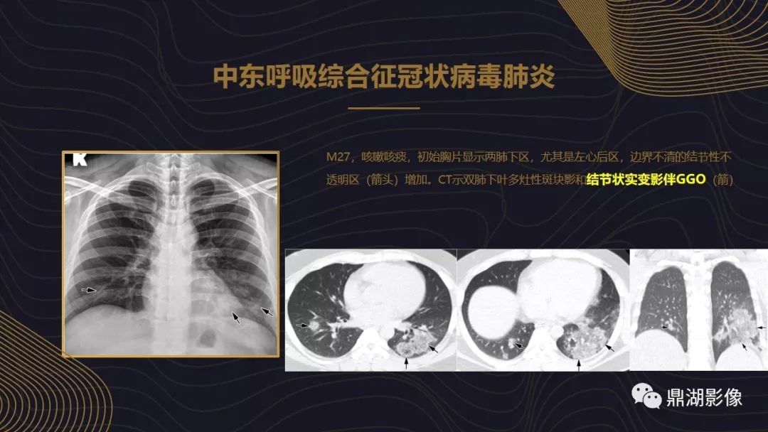 【PPT】病毒性肺炎的相关知识学习