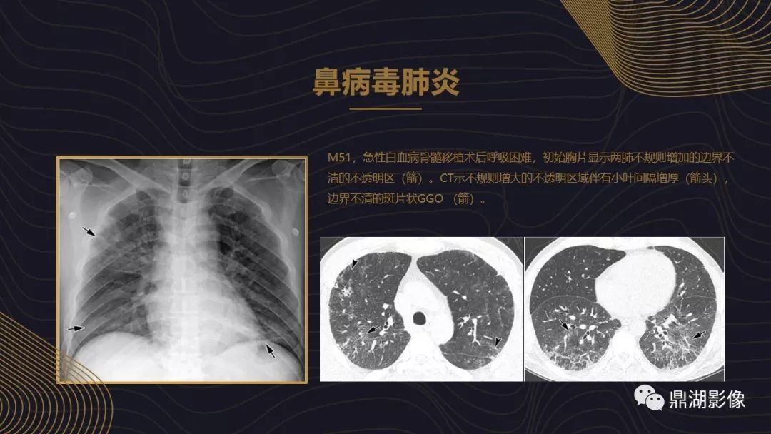 【PPT】病毒性肺炎的相关知识学习
